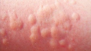 Крапивница у детей симптомы