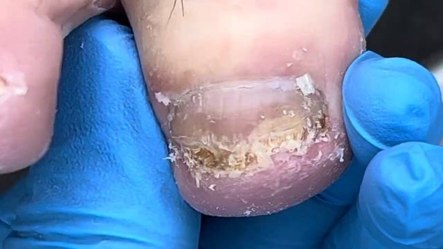 The patient's toenails have not been cut for two months and she needs a pedicure.【Xue Yidao】 смотреть онлайн