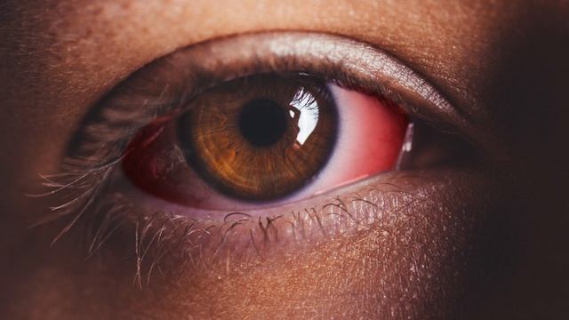 What Is Pink Eye And Conjunctivitis and How Do I Treat It? (2023) смотреть онлайн