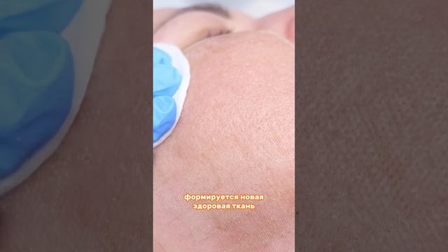 Как избавиться от ШРАМОВ после АКНЕ? Результат до и после. Лазерная шлифовка лица CO2 смотреть онлайн