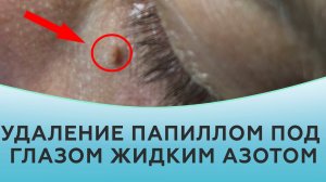 Удаление папиллом под глазом жидким азотом