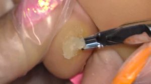 ТРИ Стержня ?!?СТЕРЖНЕВАЯ МОЗОЛЬ.Убрать НАТОПТЫШ на НОГАХ. ГЛУБОКАЯ МОЗОЛЬ.Педикюр.MASSIVE CORN