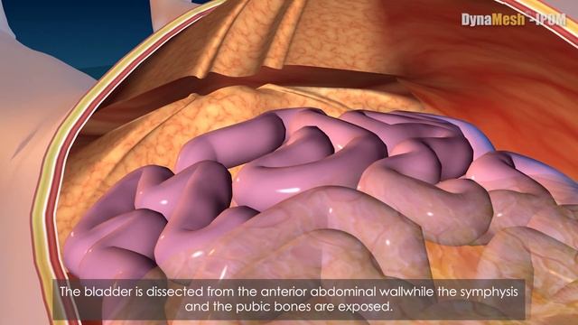 DynaMesh®-IPOM - Animation: Laparoscopic Repair of Incisional Hernia смотреть онлайн