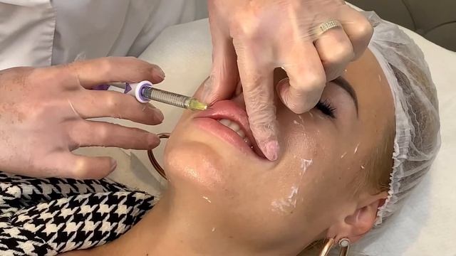 БИОРЕВИТАЛИЗАЦИЯ AQUASHİNE + УВЕЛИЧЕНИЕ ГУБ JUVEDERM/ VLOG # 48 смотреть онлайн