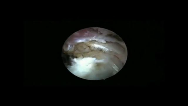 Arthroscopic Suprapectoral Tenodesis Of The Long Head Biceps: Reproducing An Anatomic ...Video 4
