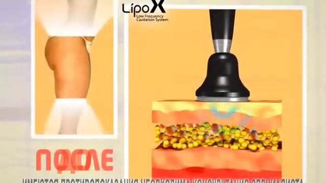 Ультразвуковая липосакция смотреть онлайн