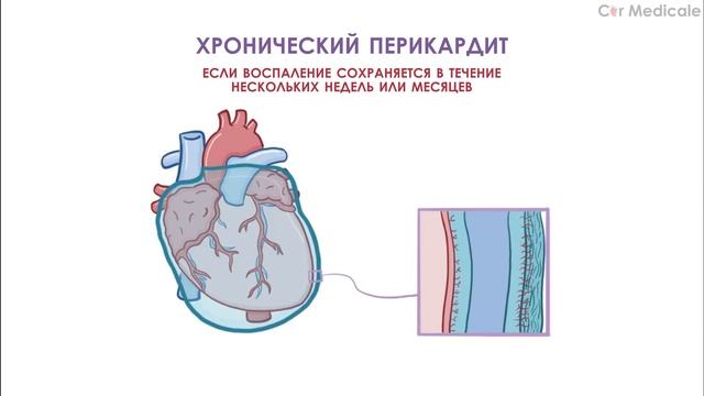 Перикардит