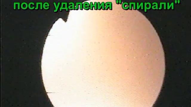 Выпадение спирали из матки в цервикальный канал. смотреть онлайн