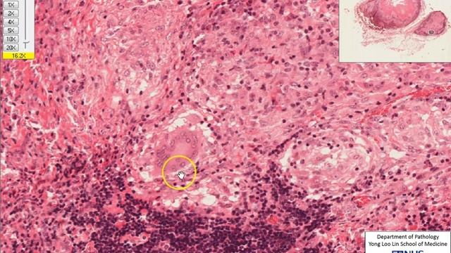 Lymph node: Granulomatous lymphadenitis microscopy смотреть онлайн