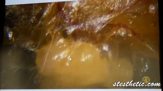 Наполнение тканей филлером