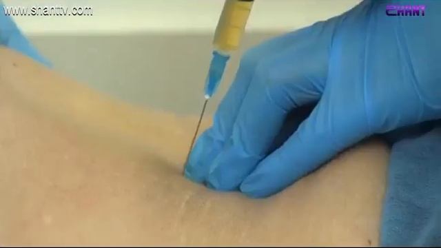 PRP թերապիա (պլազմաթերապիա) смотреть онлайн