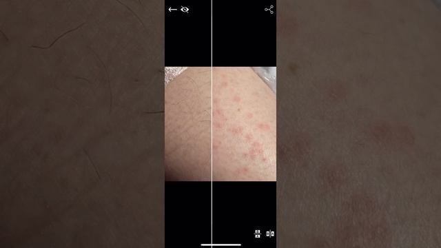 Электроэпиляция до/сразу после смотреть онлайн