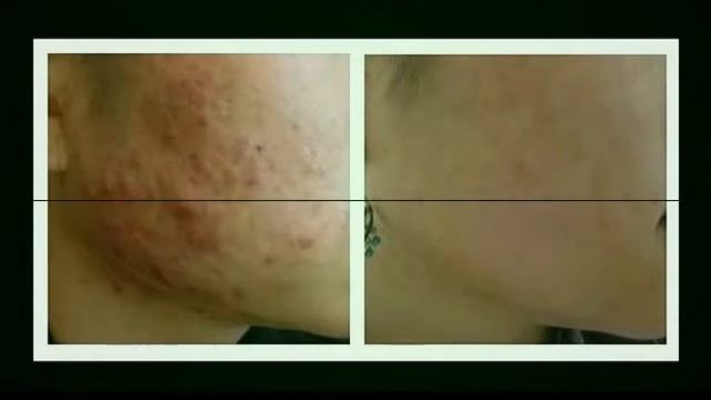 кэррот маск хендель средство от угрей и прыщей88833 смотреть онлайн