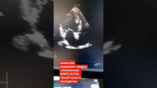 Акинезия верхушки сердца,гипокинезия МЖП, ЗСЛЖ.Тромб левого желудочка. Фракция выброса сердца 34% смотреть онлайн