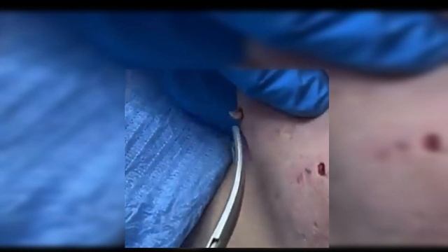 Гигантская Черная Точка/  BLACK HEAD REMOVAL