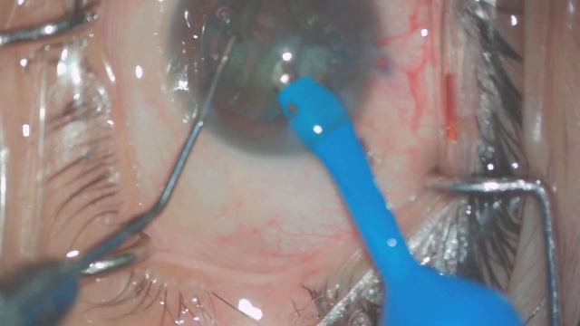 Phacoemulsification of grade 2 cataract using Stellaris PC machine and direct chop(unedited) смотреть онлайн