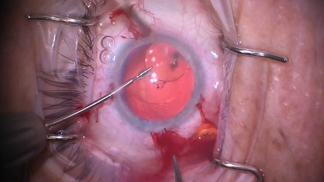 Exchange of Crystalens with Pars Plana Anterior Vitrectomy смотреть онлайн