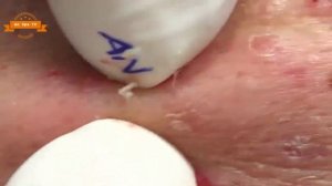 Удаление прыщей с носа и щек Spa G #064