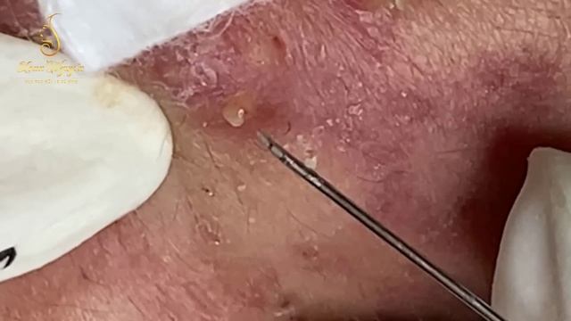 Loan Nguyen Acne Treatment 0941hn смотреть онлайн