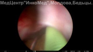 Камень левого мочеточника