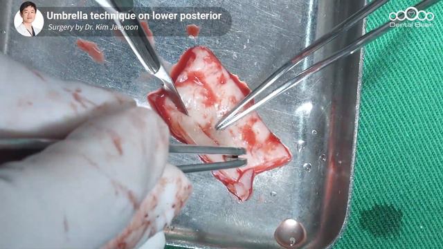 [MULTI_SUB] Umbrella technique on lower posterior with implant 2nd surgery [Dr. Kim Jaeyoon] смотреть онлайн