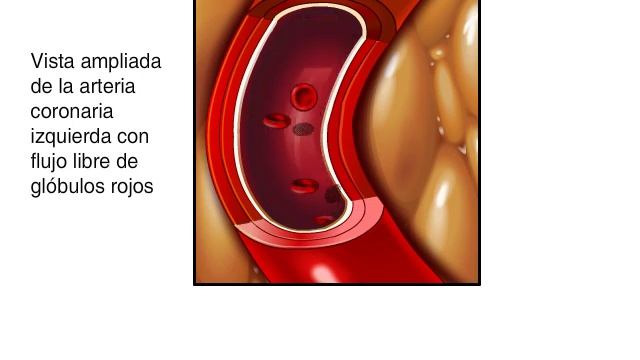 Enfermedad de la arteria coronaria смотреть онлайн