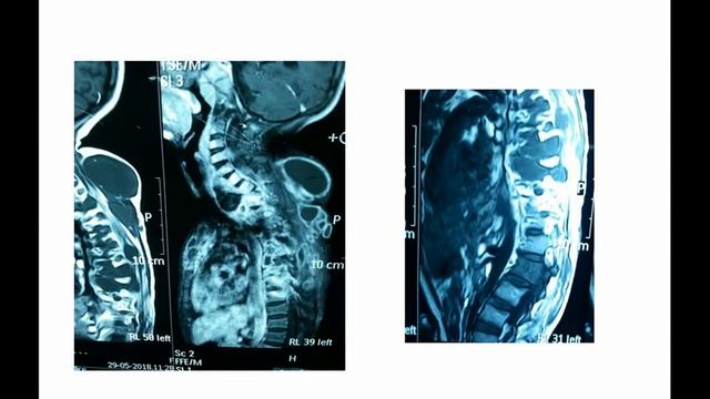 Extrapulmonary Tuberculosis смотреть онлайн