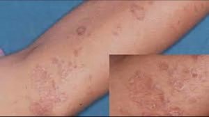 Как лечить и вылечить плоский лишай