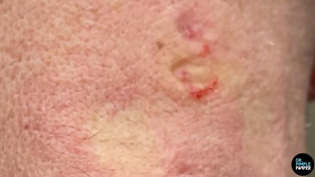 To Blackheads & Beyond! смотреть онлайн