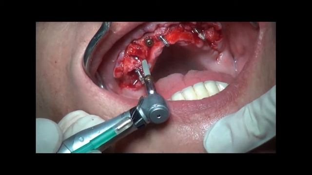Clinical Case BEGO Semados® Mini Easy Con Provisonal Implantat смотреть онлайн