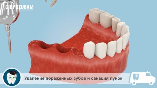 Имплантация зубов. 5 методов имплантации зубов