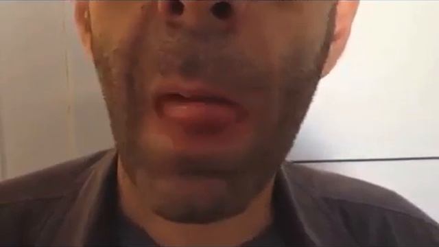 Palsy and Recovery from Palsy of the Right Hypoglossal Nerve смотреть онлайн