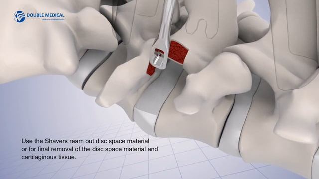 Double Medical Transforaminal Lumbar Interbody Fusion Cage (TLIF) смотреть онлайн