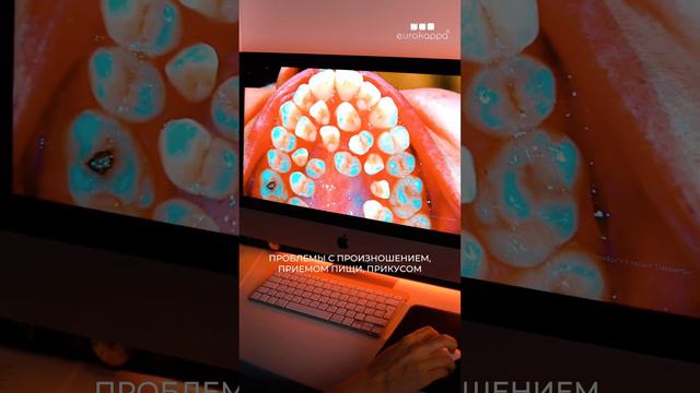 Гипердонтия😱 #eurokappa #еврокаппа #зубы #улыбка #стоматолог смотреть онлайн
