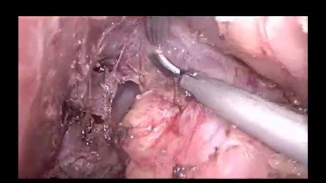 Minimally Invasive Esophagectomy (MIE) with celiac node dissection смотреть онлайн