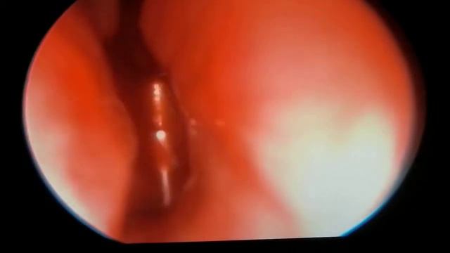 Аденотомия шейверная