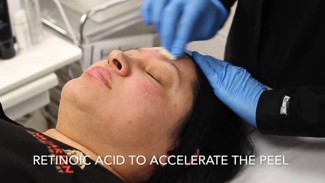 Rejuvenize Chemical Peel | Nazarian Plastic Surgery смотреть онлайн