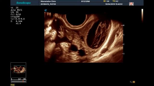 Визуализация МАТОЧНОЙ ТРУБЫ смотреть онлайн