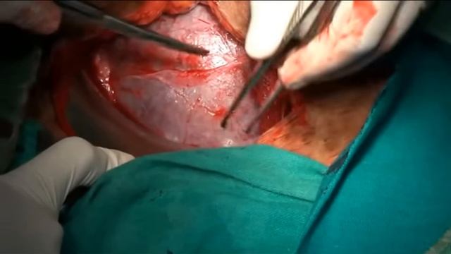 C Section Video смотреть онлайн