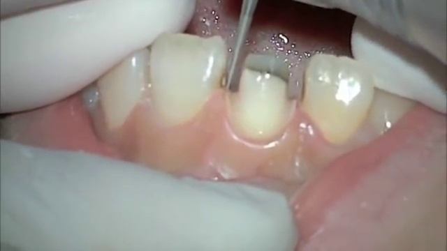 Tooth preparation for All-ceramic crown смотреть онлайн