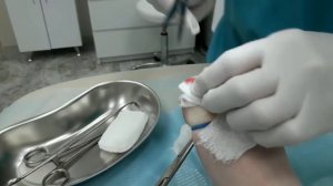 Удаление вросшего ногтя с применением радиоволны