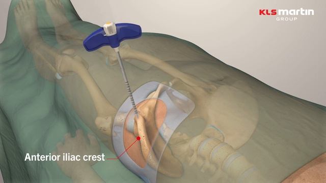 Marrow Marxman™ bone marrow aspiration system смотреть онлайн