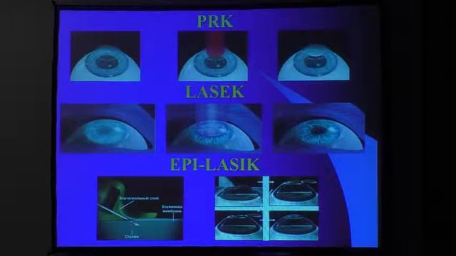 Абберации глаза и их роль в рефракционной хирургии роговицы смотреть онлайн