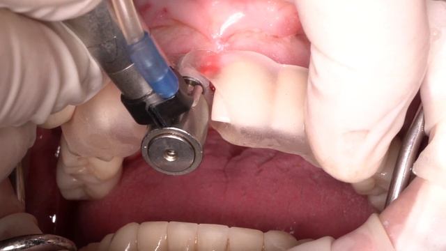 SOCKET SHIELD - DOUBLE GUIDE technique - CONNECT ABUTMENT смотреть онлайн