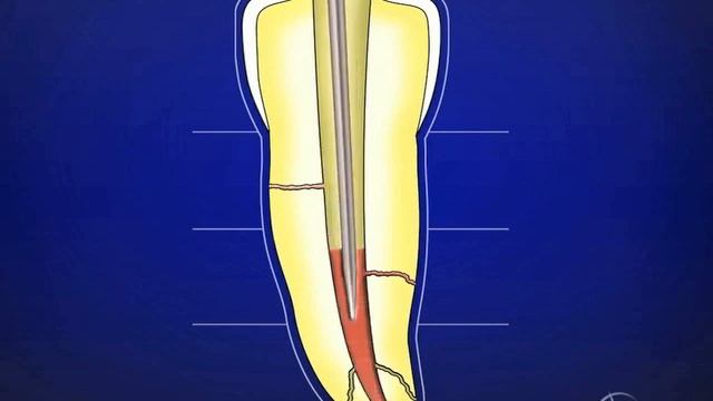 Vertical Condensation Technique: Step-by-Step Graphic Sequence смотреть онлайн