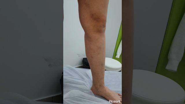 Результат операция удаления варикоза через год. Сосудистый хирург. Флеболог. Флеболог Москва смотреть онлайн