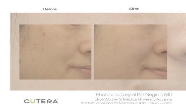 Cutera LimeLight Laser смотреть онлайн