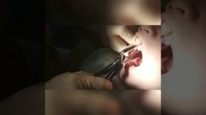 Удаление молочного зуба ребёнку с использованием анестезии.