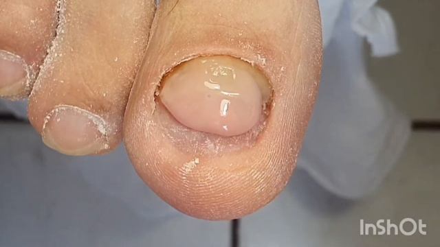 Протезирование ногтей. Грибок ногтей. Аппаратный педикюр. смотреть онлайн