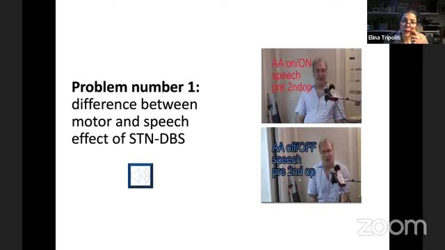 #CNStalk - Elina Tripoliti on Parkinson Disease and its impact on speech смотреть онлайн